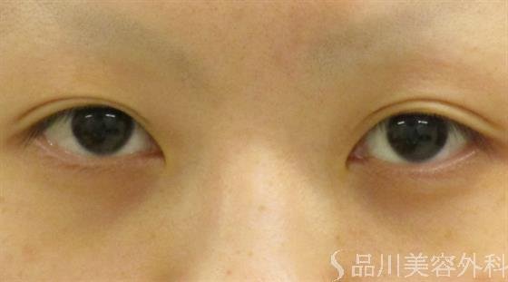 症例NO.41633のBEFORE写真
