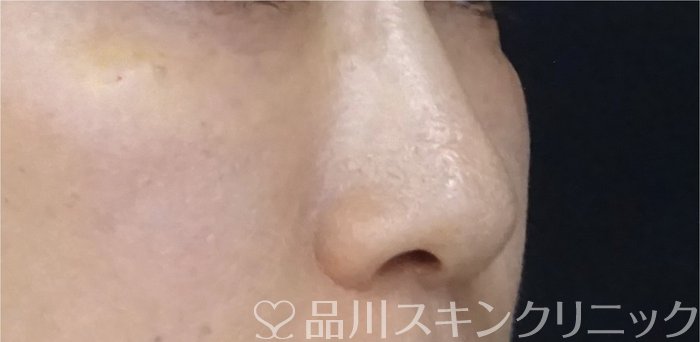 症例NO.69903のAFTER写真