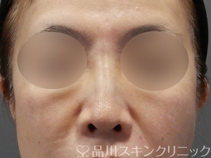 症例NO.75044のAFTER写真