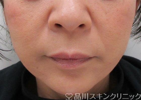 症例NO.34502のAFTER写真