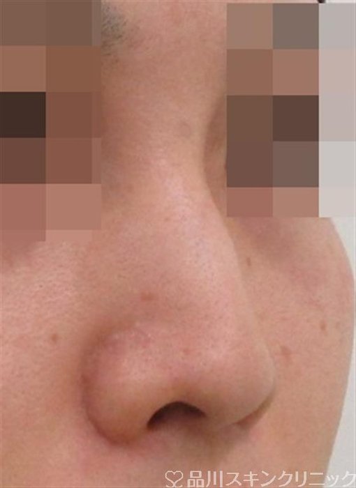 症例NO.39009のBEFORE写真