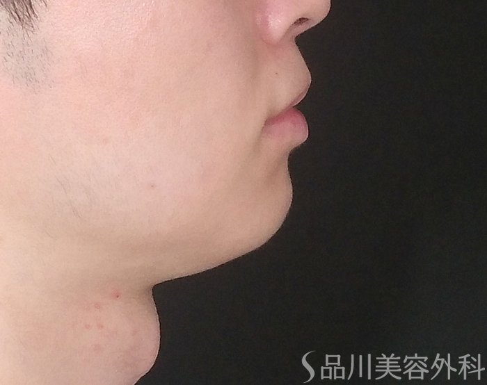 症例NO.67586のBEFORE写真