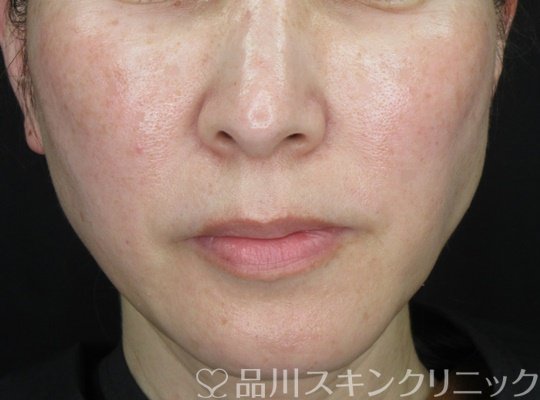 症例NO.70364のAFTER写真
