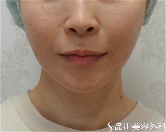 症例NO.35067のAFTER写真