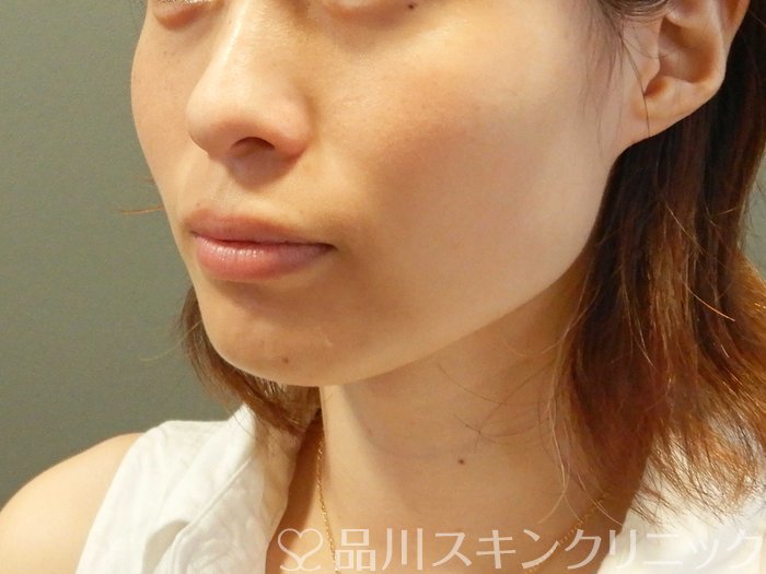 症例NO.66268のBEFORE写真