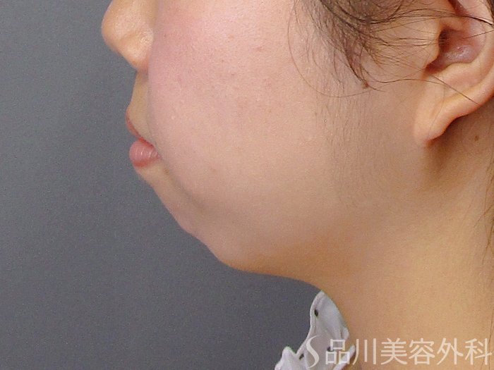 症例NO.75059のBEFORE写真