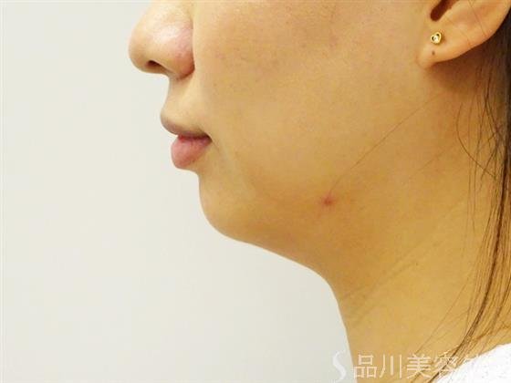 症例NO.53080のBEFORE写真