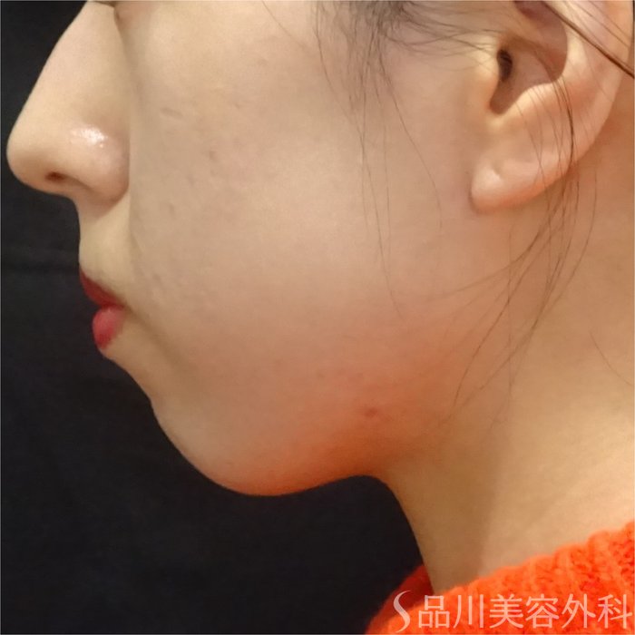 症例NO.68248のBEFORE写真