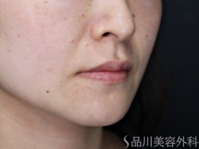 症例NO.70586のBEFORE写真