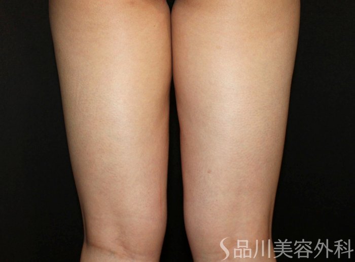 症例NO.73720のBEFORE写真