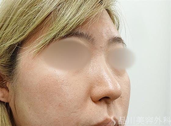 症例NO.33581のBEFORE写真