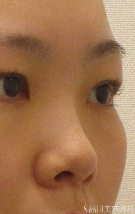 症例NO.65341のBEFORE写真