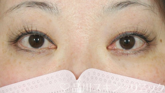 症例NO.72430のBEFORE写真