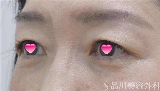 症例NO.52440のAFTER写真