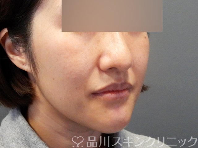 症例NO.69998のBEFORE写真