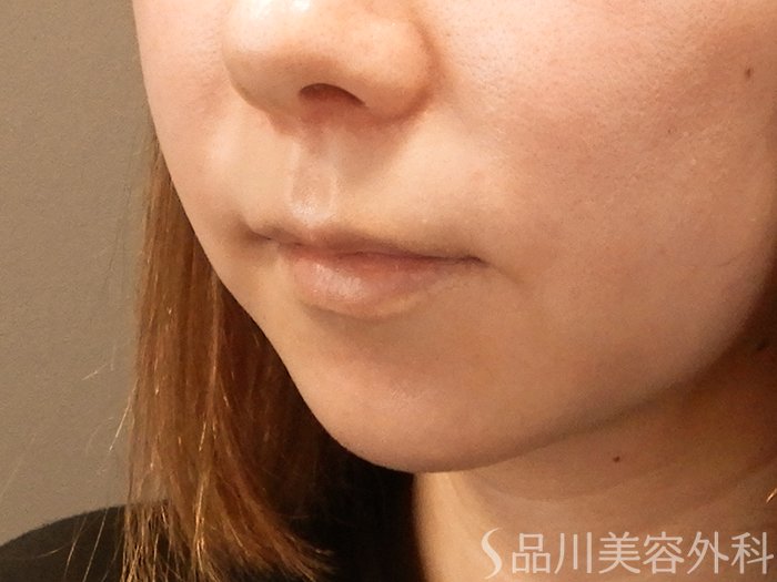 症例NO.70058のBEFORE写真