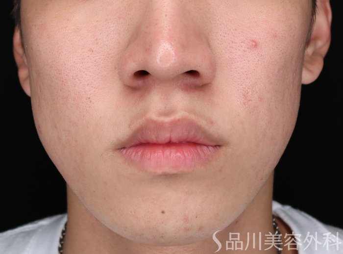 症例NO.65511のBEFORE写真