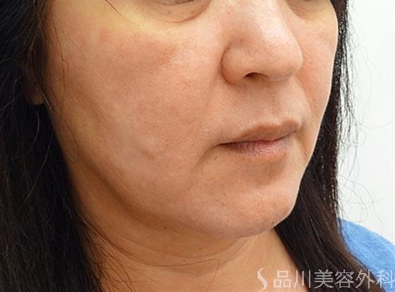症例NO.36277のBEFORE写真