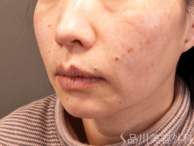 症例NO.70489のAFTER写真