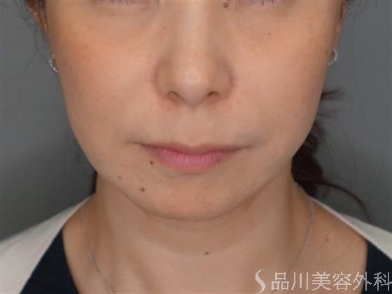 症例NO.52651のBEFORE写真