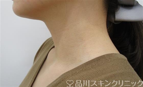 症例NO.39241のAFTER写真