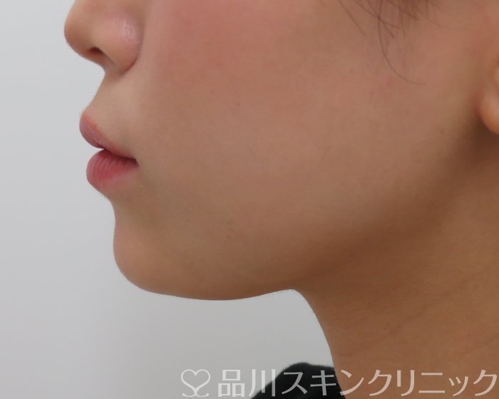 症例NO.65630のAFTER写真
