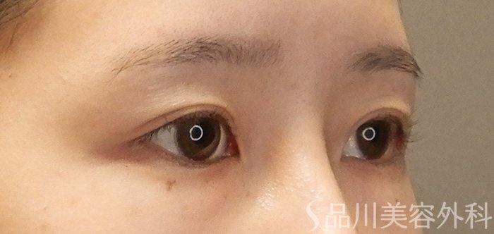 症例NO.68027のBEFORE写真