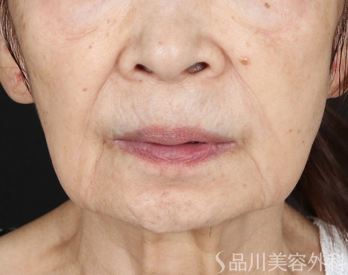 症例NO.73955のBEFORE写真
