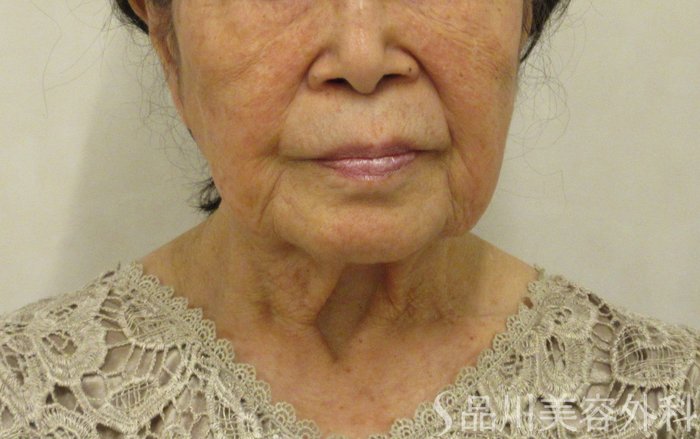 症例NO.72613のBEFORE写真