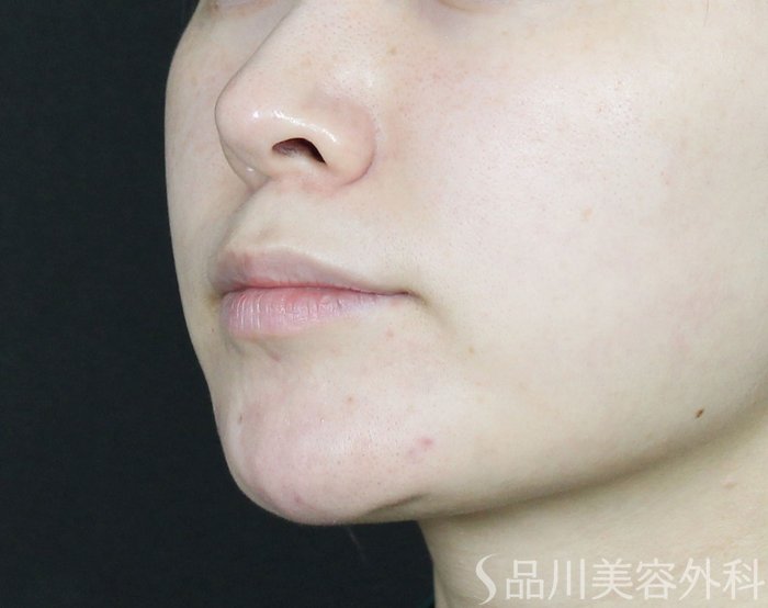 症例NO.70213のBEFORE写真