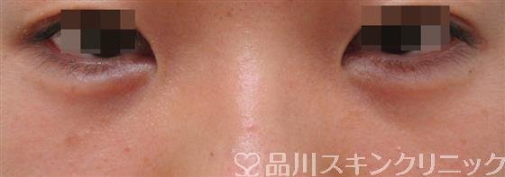 症例NO.31356のAFTER写真