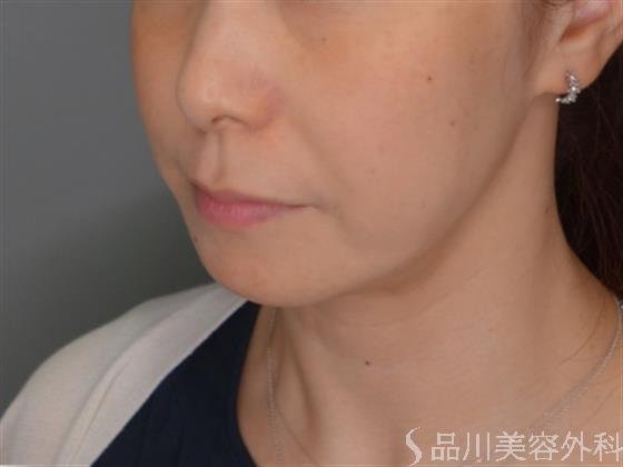 症例NO.52651のBEFORE写真