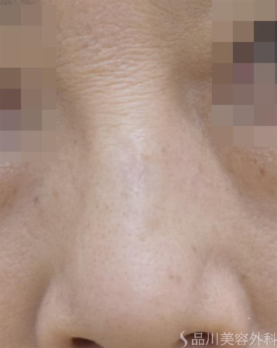 症例NO.58478のAFTER写真