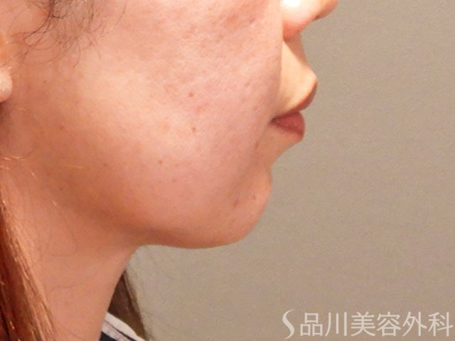 症例NO.69577のBEFORE写真