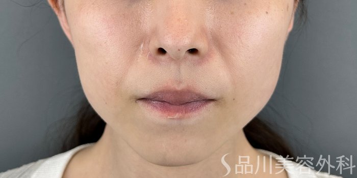 症例NO.71077のAFTER写真