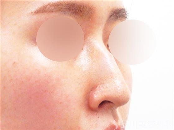 症例NO.56936のBEFORE写真