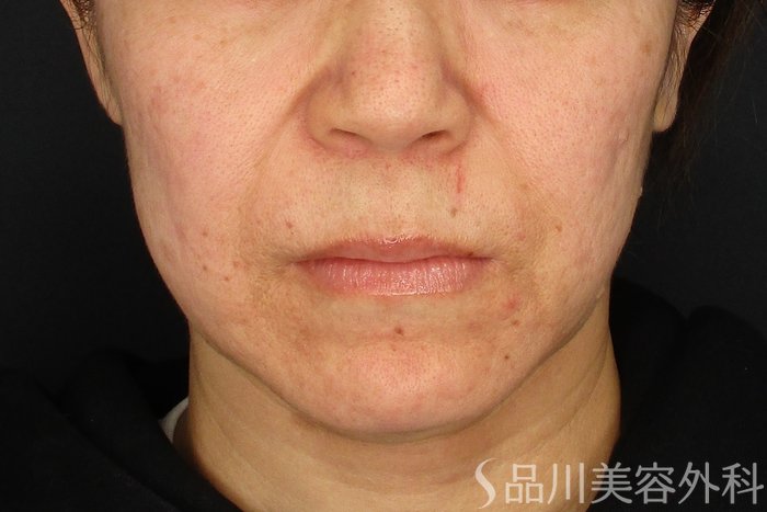 症例NO.73233のBEFORE写真