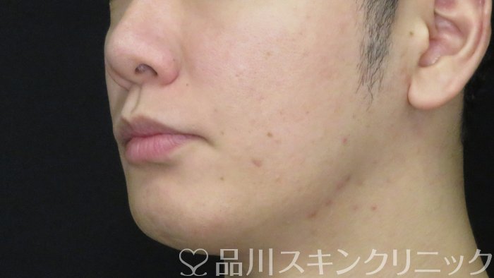 症例NO.71731のBEFORE写真