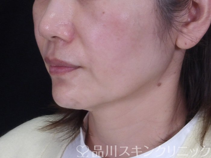 症例NO.72560のBEFORE写真