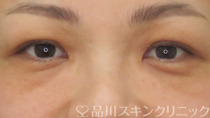 症例NO.72909のBEFORE写真
