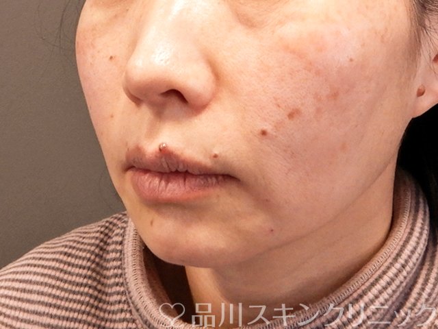 症例NO.70489のAFTER写真