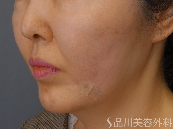 症例NO.73688のAFTER写真