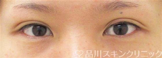 症例NO.44428のAFTER写真
