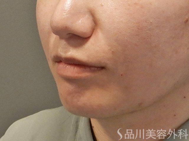 症例NO.73770のAFTER写真