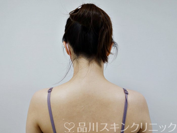 症例NO.73137のBEFORE写真