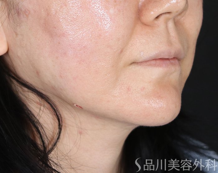 症例NO.73633のAFTER写真