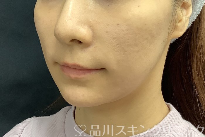 症例NO.69842のAFTER写真