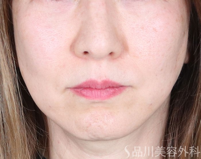 症例NO.73006のAFTER写真