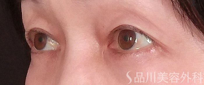 症例NO.69940のBEFORE写真