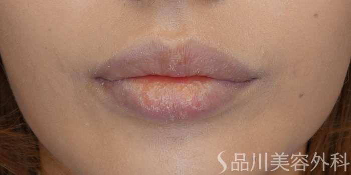 症例NO.71474のBEFORE写真
